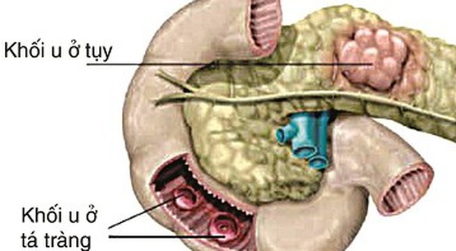 Hội chứng Zollinger-Ellison - Hình ảnh minh họa